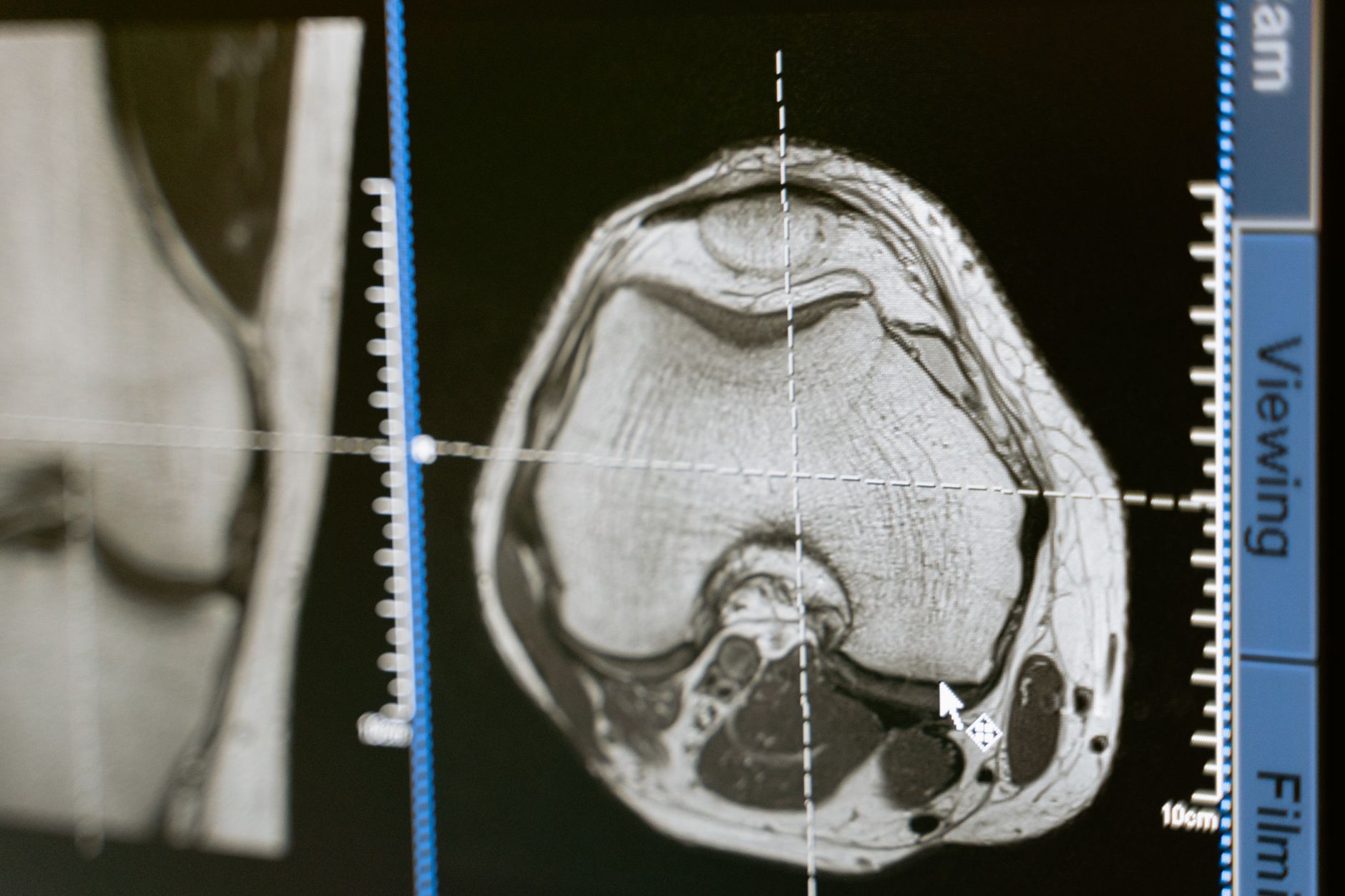 Radiology imaging used to size peripheral lung nodules before bronchoscopic biopsy.